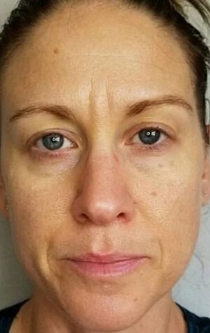 At the age of 40, deep folds and age spots appeared