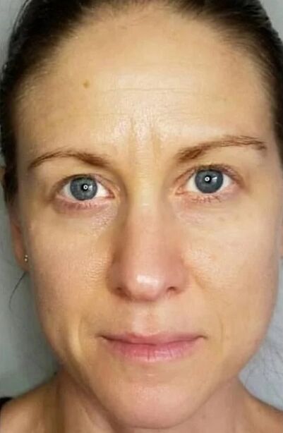 Simpla 360 contributed to rejuvenating the skin and lightening the stains