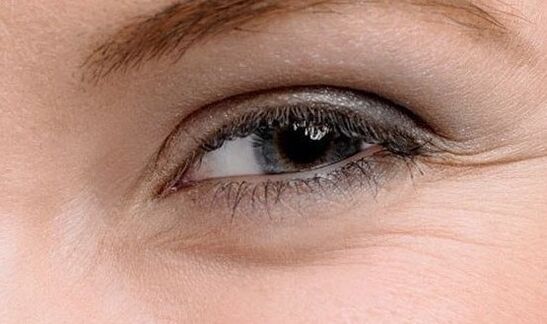 Fold in the corner of the eye